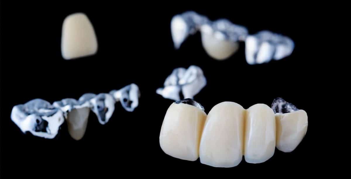 Dental Crowns in Spruce Grove, AB, T7X 3X2 Porcelain Crowns Near Me