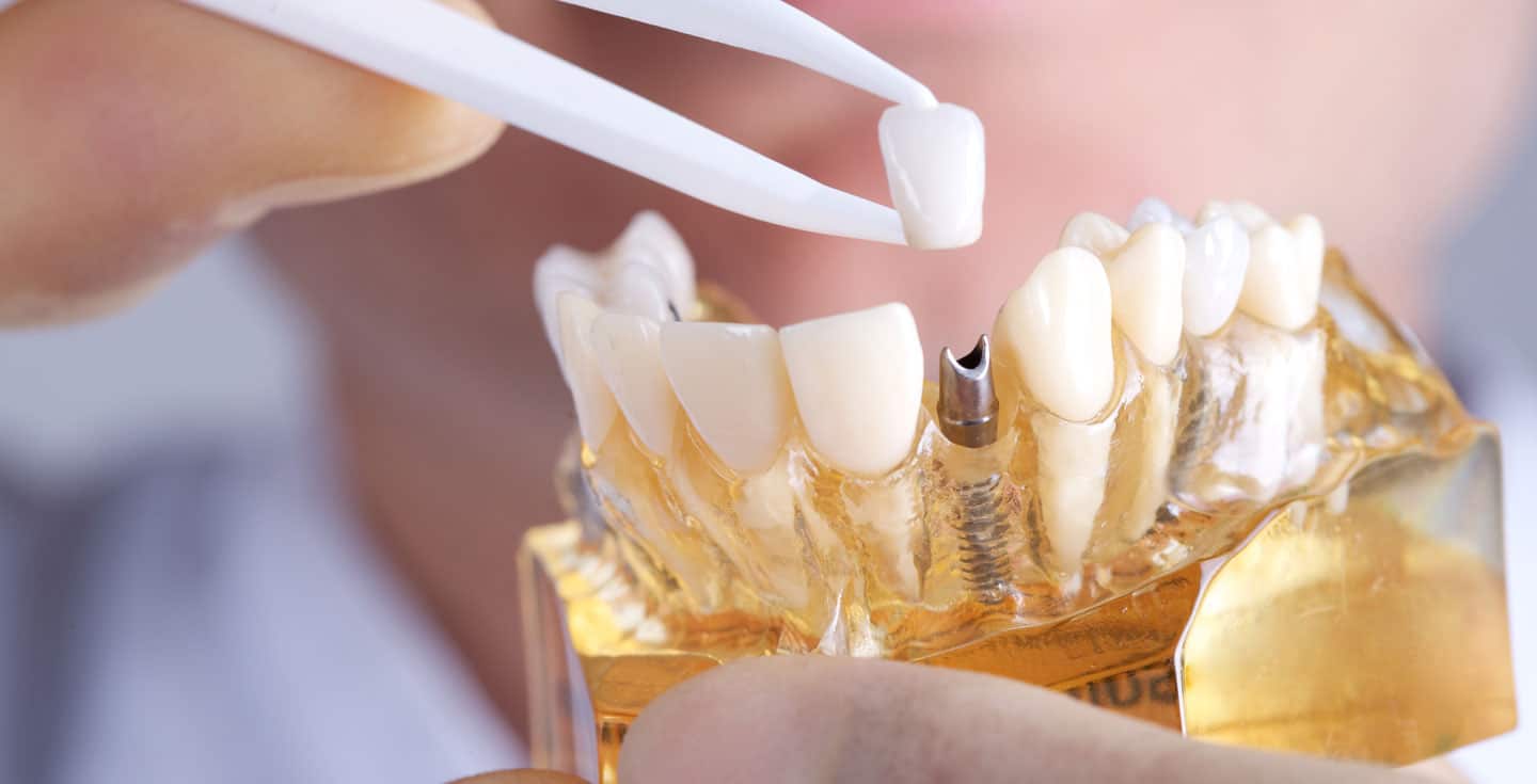 dental implants in spruce grove