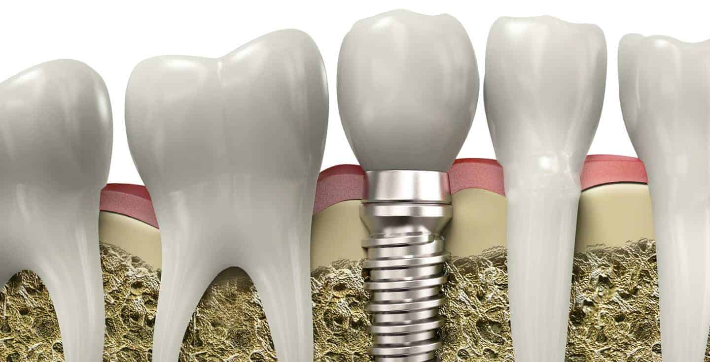 dental implants near you