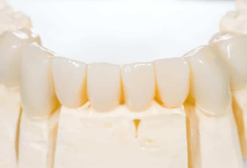 dental bridges in spruce grove