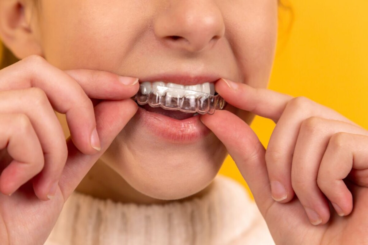 invisalign step by step guide which teeth move first