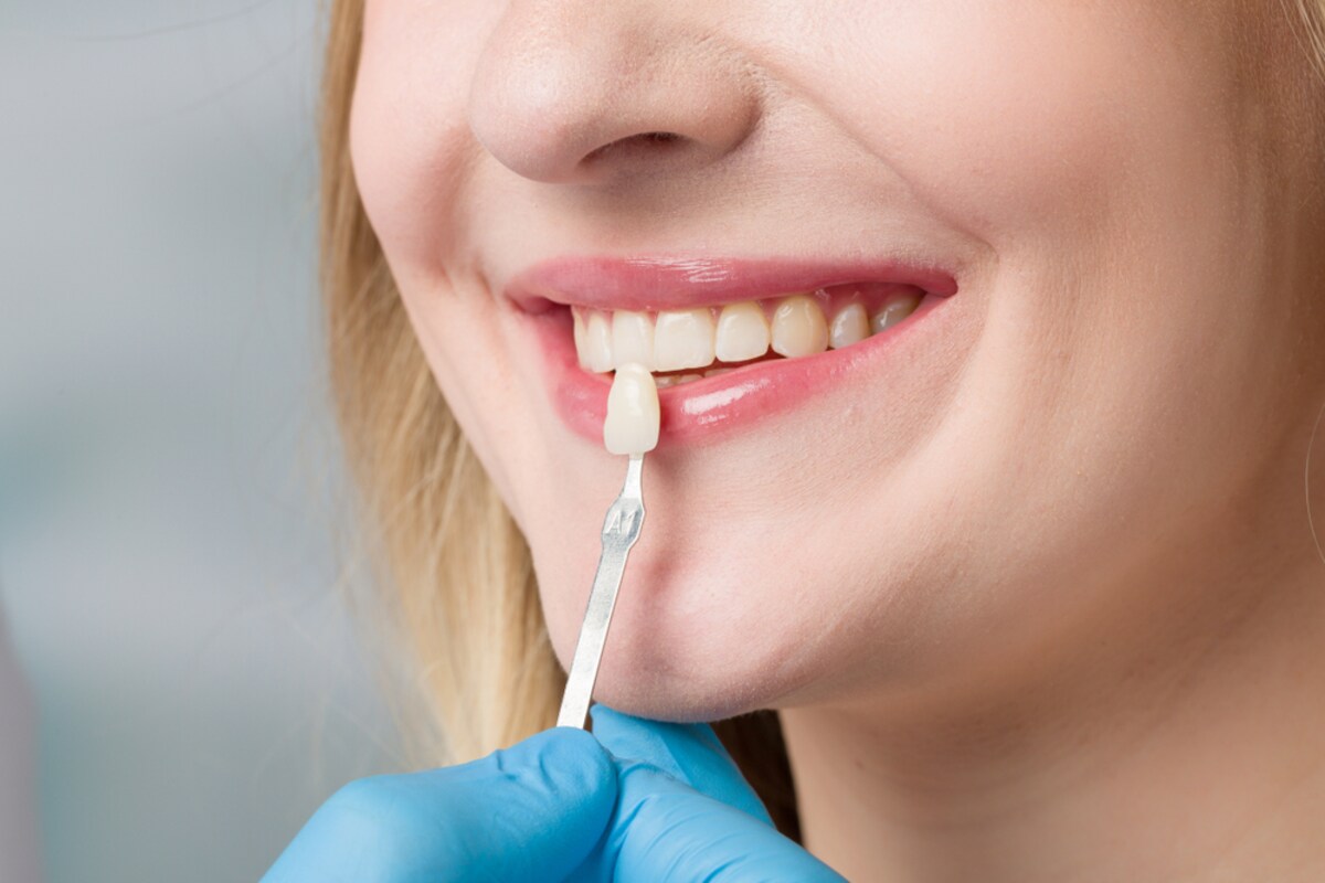 porcelain veneers pros cons smile benefits