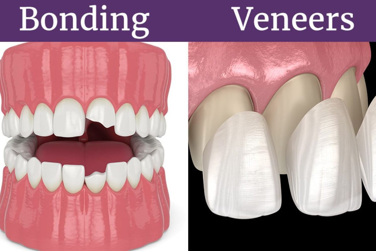 dental bonding vs veneers key differences explained