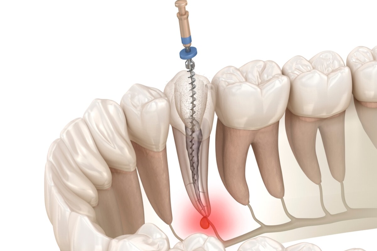 tips for quick recovery after a root canal