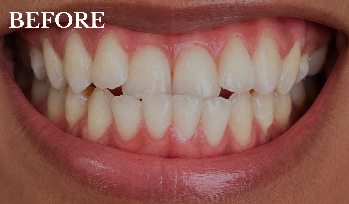 Cynthia before invisalign treatment