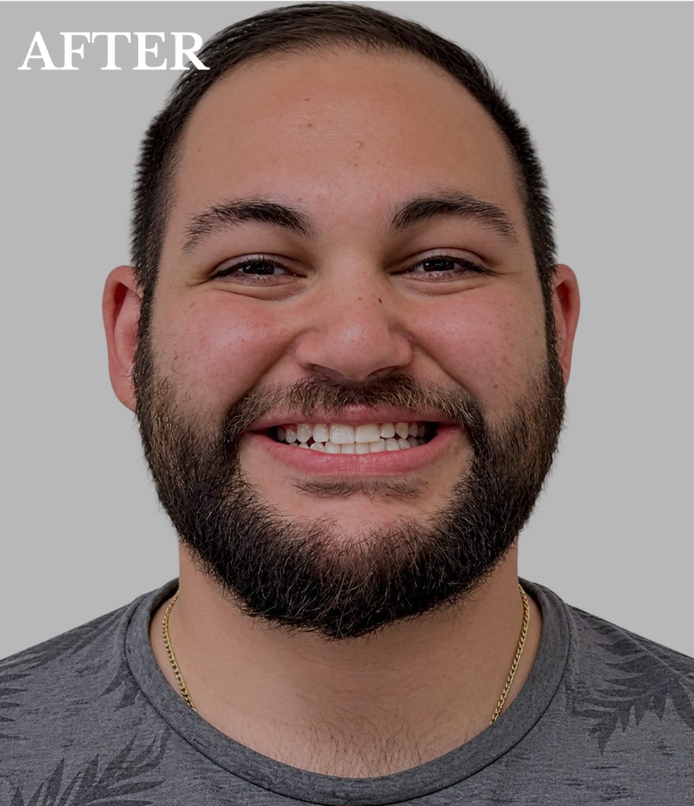 Nander after invisalign treatment