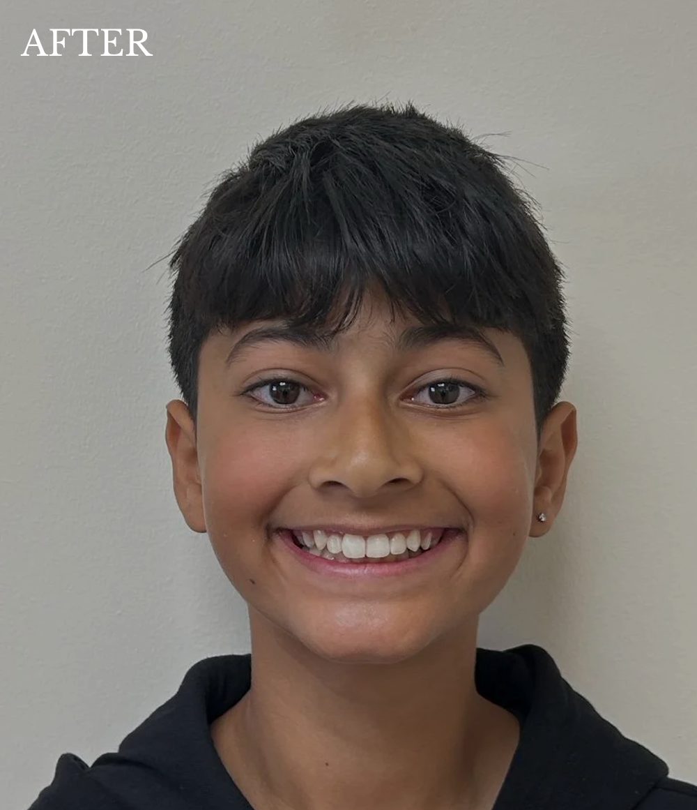 aarjav after invisalign treatment
