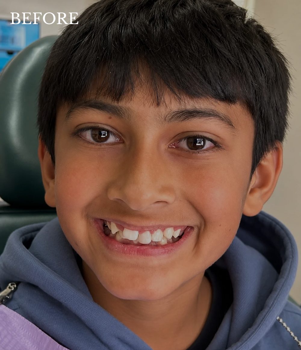 aarjav before invisalign treatment