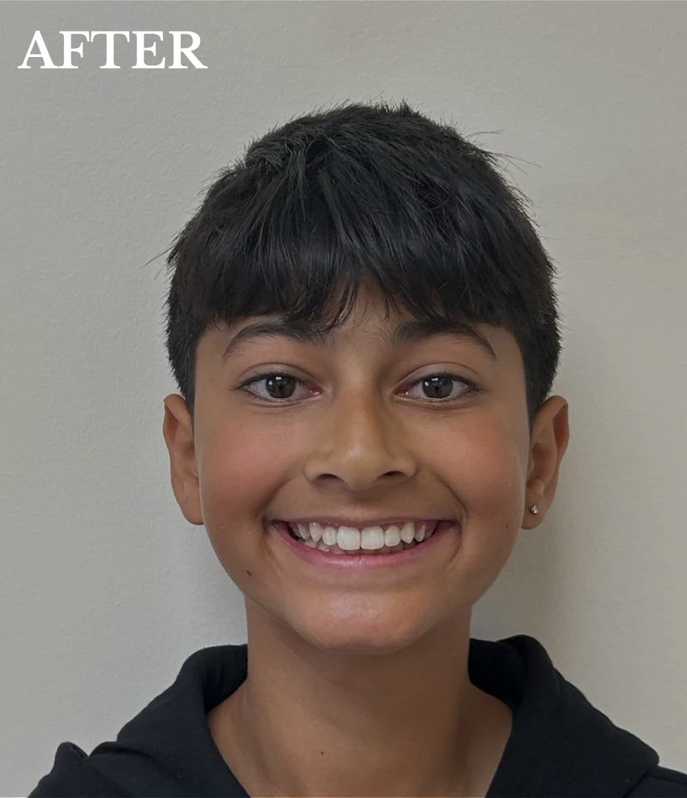 aarjav after invisalign treatment