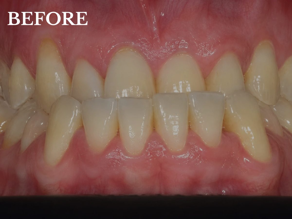 ian before invisalign treatment