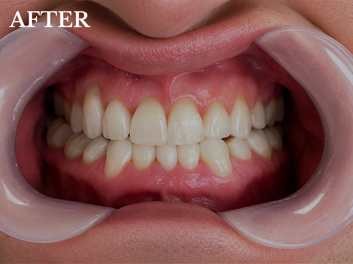 ian After invisalign treatment
