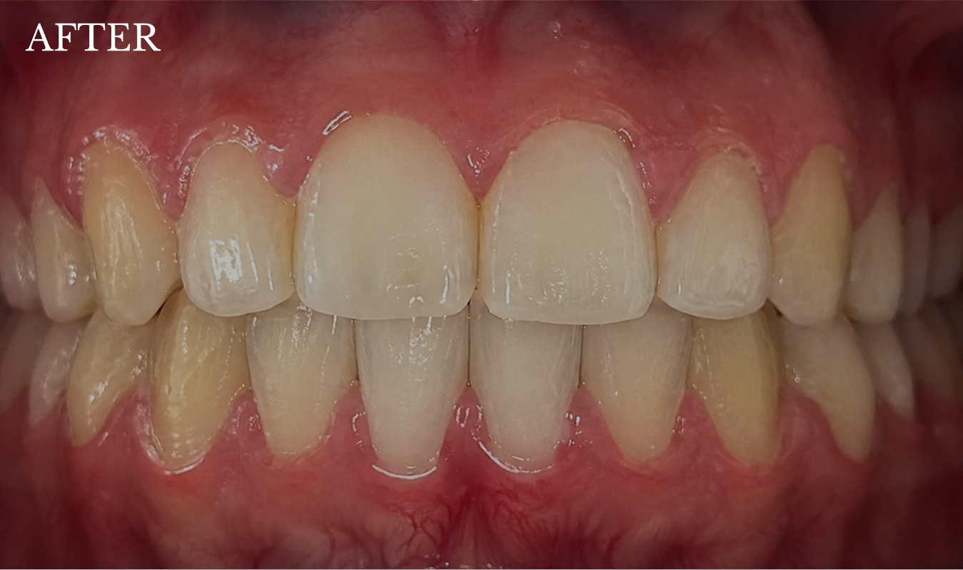 jaila after treatment invisalign