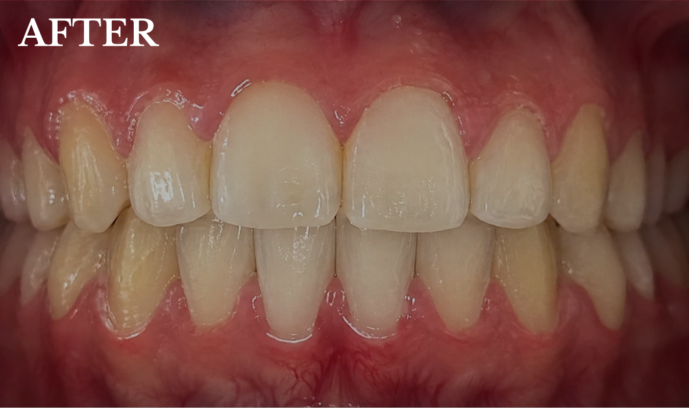 jaila after treatment invisalign