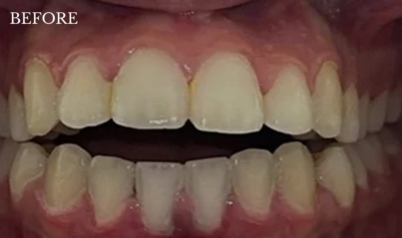 jaila-before-treatment-invisalign