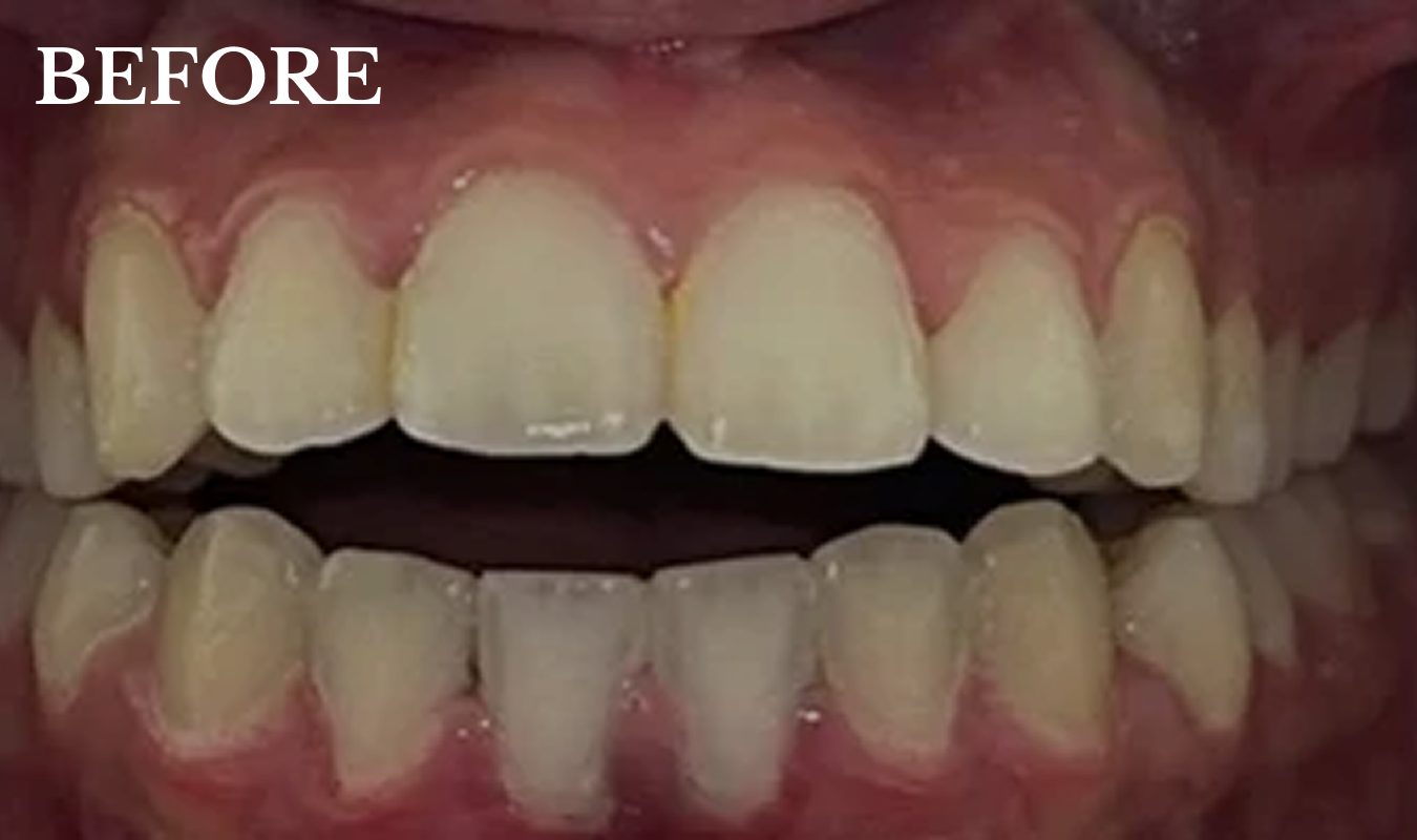 jaila-before-treatment-invisalign