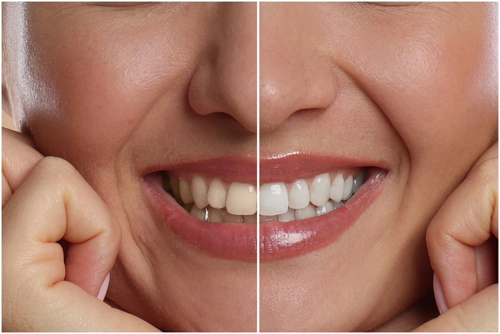 porcelain-veneers-vs-teeth-whitening-which-fixes-discoloration-better